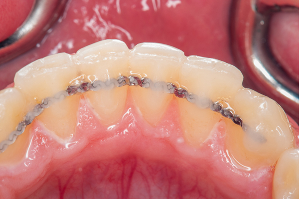 Festsitzender Retainer auf den Zähnen nach fester oder loser Zahnspange